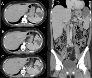 Tomografía abdominal contrastada. A)Tomografía, corte axial, fase portal. Se aprecia imagen hipocaptante hipodensa, en forma de cuña, con punta orientada hacia el hilio en aspecto anterosuperior de parénquima esplénico. B y C)Imágenes hipocaptantes hipodensas múltiples, la más grande en forma de cuña con punta orientada hacia el hilio en aspecto anterosuperior de parénquima esplénico y otras más pequeñas. D)Reconstrucción coronal. Se evidencian múltiples imágenes hipocaptantes, la mayor de ellas ubicada predominantemente en el polo superior del bazo, con forma de cuña en el parénquima esplénico y punta hacia el hilio, que abarca el 40% del volumen del bazo correspondiente a infartos esplénicos.