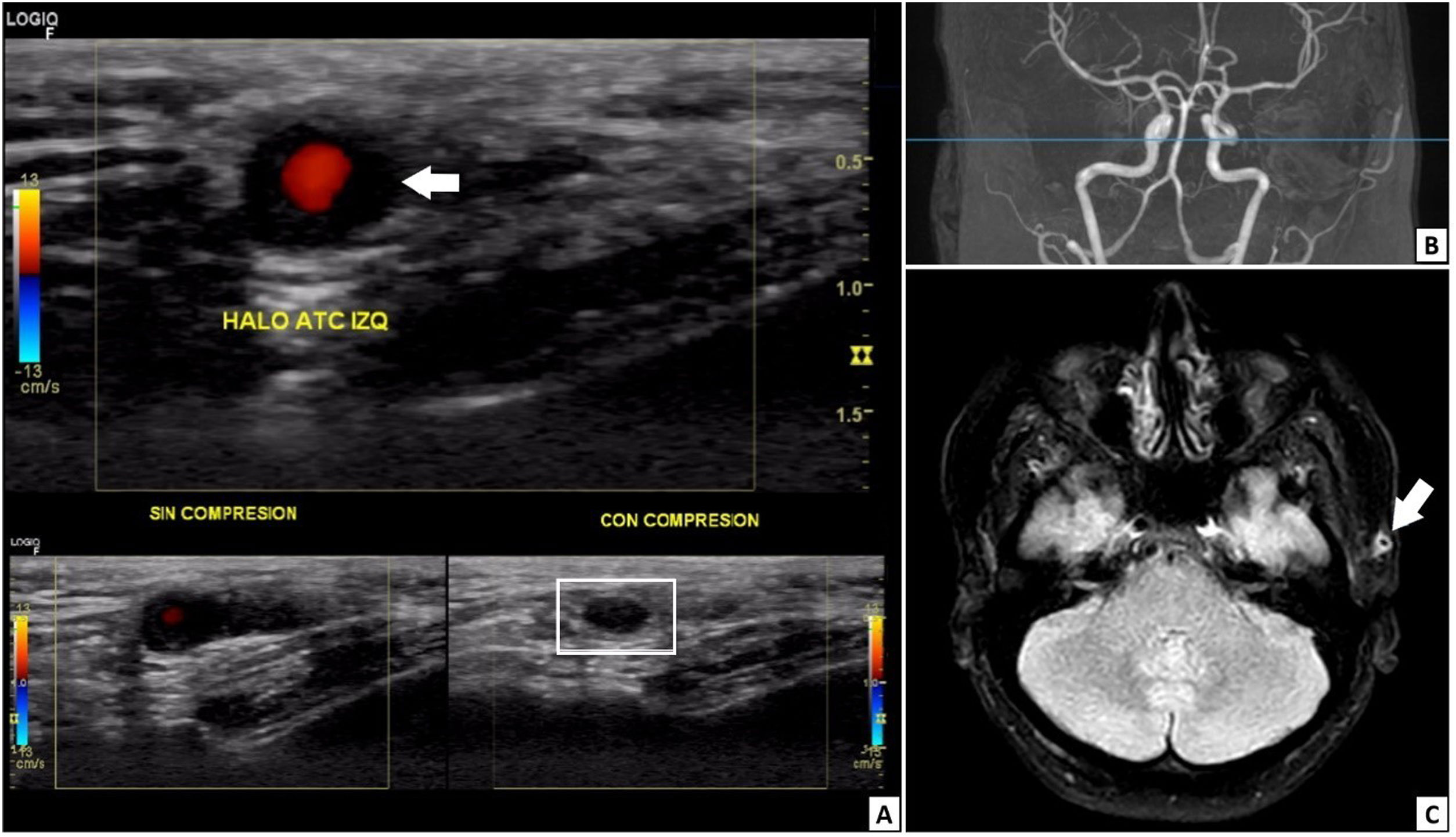 Temporal arteritis caused by eosinophilic vasculitis associated with a ...