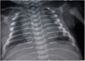 X-ray of the chest with increased rib and arm bone density.