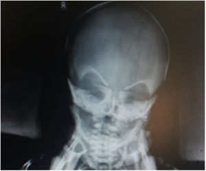Facial imaging and diagnosis of osteoporosis with eye symptoms.