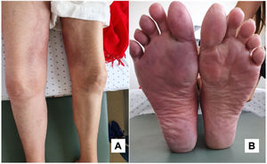 Lesions of the lower limbs. Panel A. Medial surface of the right thigh: warm, tenderness, mild induration and associated erythema. Panel B. Left leg: her left leg was cold; both soles of her feet had violaceous discoloration, which was more pronounced in the right foot.