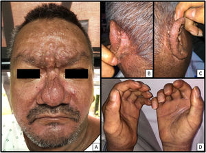 Lesiones en piel de paciente con escleromixedema. A) Piel brillante e indurada de manera difusa en el rostro. En región frontal, glabelar, ciliar y dorso nasal se observan pápulas céreas, confluentes y algunos nódulos subcutáneos. Pliegue longitudinal profundo en región glabelar, madarosis. Facies leonina. B y C) Región posterior de ambos pabellones auriculares con pápulas monomorfas, eucrómicas, de consistencia firme, en forma de cúpula y dispuestas linealmente. D) Esclerodactilia sin fenómeno de Raynaud con piel de aspecto brillante y contracturas fijas en flexión.