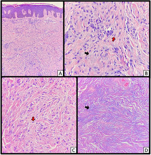 Tríada típica en histopatología de piel en escleromixedema. A y B) Hematoxilina y eosina - pápula en pabellón auricular izquierdo: fibrosis, proliferación de fibroblastos con aspecto alargado o estrellado (flechas rojas), dispuestos de forma irregular y depósitos intersticiales de mucina en la dermis reticular superior y media (flechas negras). Imágenes tomadas en 4X (A) y en 40X (B). C) Hematoxilina y eosina - piel de mano izquierda en 40X. D) Alcian Blue mostrando depósito intersticial de mucina en medio de las fibras de colágeno (flechas negras) en 40X.
