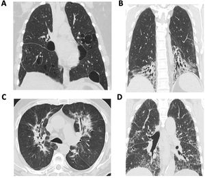 Distinct radiographic patterns of ILD in autoimmune rheumatic diseases. A=lymphocytic interstitial pneumonitis; B=non-specific interstitial pneumonia; C=organizing pneumonia; D=usual interstitial pneumonia.