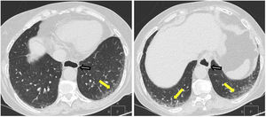(A, B) High resolution computed tomography demonstrating NSIP with subpleural ground-glass opacities (short arrows) with traction bronchiectasis (arrows) and sparing of the subpleural lung.