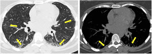 (A) NSIP with subpleural multifocal patchy ground-glass opacities (arrows); (B) subpleural dendriform ossification is also observed (arrows).
