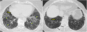 (A, B) Fibrotic NSIP with subpleural sparing. HRCT shows multifocal patchy ground-glass opacities (short arrows) with traction bronchiectasis (arrows) and sparing of the subpleural lung (black arrows).