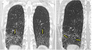 (A) Fibrotic NSIP with lower bilateral ground-glass opacities (arrows) and (B) multiple traction bronchiectasis (arrows).