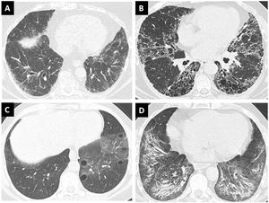 Patterns of high-resolution computed tomography of the chest in interstitial lung disease in Sjögren Syndrome. (A) Non-specific interstitial pneumonia, (B) usual interstitial pneumonia, (C) lymphoid interstitial pneumonia, and (D) combined pattern of non-specific interstitial pneumonia associated with organizing pneumonia.