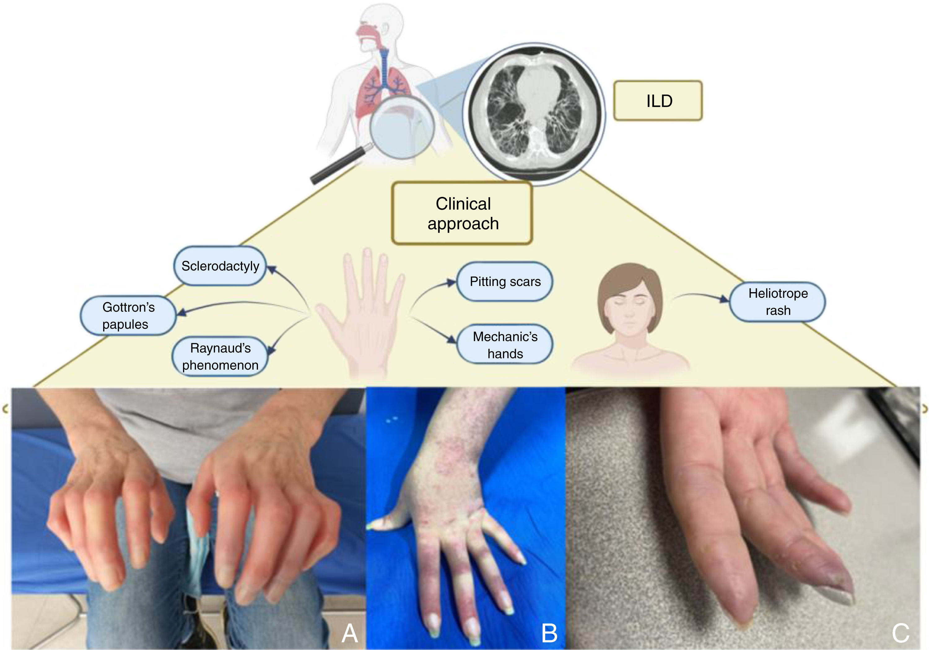 Sequential approach to interstitial lung disease: An autoimmune ...