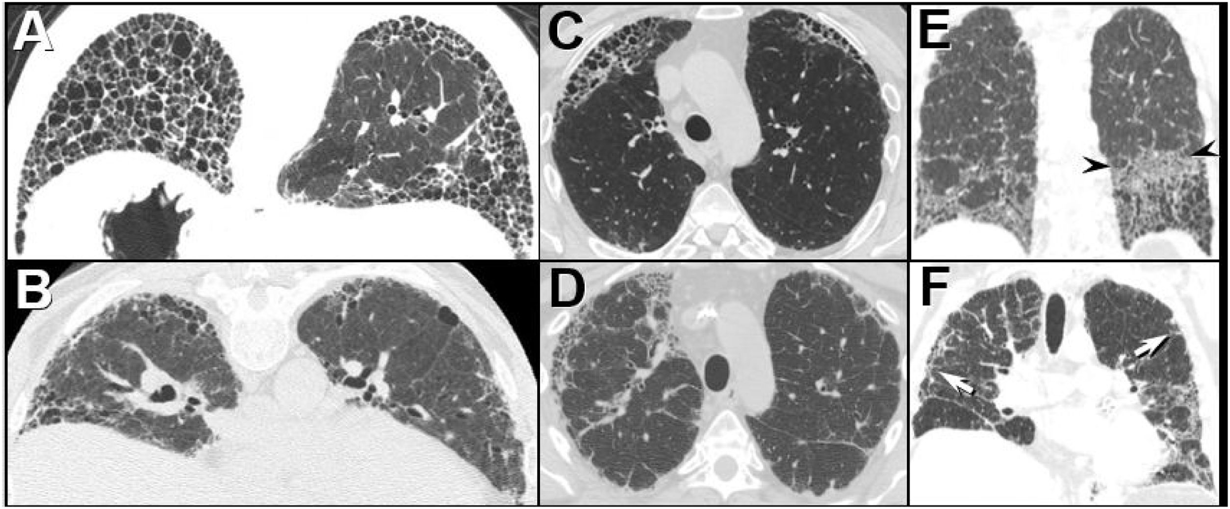Interstitial lung disease in autoimmune diseases | Revista Colombiana ...