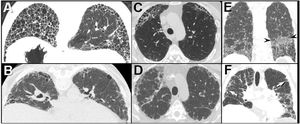 The UIP pattern: HRCT features favoring a connective tissue-associated etiology from IPF.25 (A) The “exuberant honeycombing” sign-cyst formation constituting greater than 70% of the fibrotic portions of the lung. Prone HRCT image in a patient with RA shows a UIP pattern with extensive basal honeycombing; compare with the definite UIP pattern at HRCT in an IPF patient (B). (C) The “anterior upper lobe sign”. Axial HRCT image through the upper lungs in a patient with RA shows concentrated fibrotic change with honeycombing; compare with the typical appearance of fibrotic change in the upper lobes in a patient with IPF (D). (E) The “straight-edge” sign. Coronal CT image in a patient with RA shows comparatively isolated extensive honeycombing and fibrotic change in the bases, showing a sharp demarcation in the craniocaudal plane (between arrowheads), and lack of substantial extension along the lateral pulmonary parenchyma cranially. Compare with coronal CT in a patient with IPF (F), which shows peripheral and basal predominant fibrotic lung disease, but with relatively greater lateral mid and upper lobe involvement (arrows).