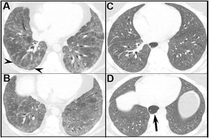 NSIP: idiopathic versus connective tissue-associated pulmonary disease. (A and B) Axial HRCT through the mid and lower lungs in a patient with idiopathic NSIP shows basal predominant ground-glass opacity, fine reticulation, and traction bronchiectasis. Note presence of subpleural sparing (arrowheads). (C and D) Axial HRCT through the mid and lower lungs in a patient with scleroderma shows findings similar to the patient with idiopathic NSIP, including basal predominant ground-glass opacity, reticulation, and traction bronchiectasis. A clue to the presence of scleroderma is the dilated esophagus (arrow).