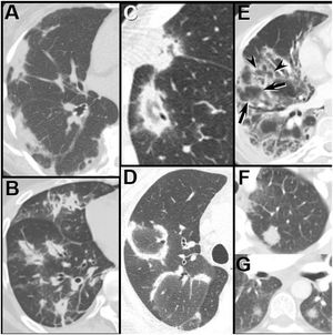 Organizing pneumonia patterns at HRCT in patients with dermatomyositis. (A) Subpleural consolidation; (B) Peribronchial consolidation; (C and D) The reverse ground-glass halo, or atoll, sign – a complete (C) or incomplete (D) ring of consolidation surrounding ground-glass opacity; (E) Perilobular opacity. Note the linear increased attenuation, simulating interlobular septal thickening outlines individual (arrowheads) and contiguous secondary pulmonary lobules (arrows), creating a polygonal appearance. (F and G) Nodules, both solid (F) and subsolid (G).