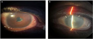 Hallazgos al examen físico oftalmológico al ingreso. A) Ojo derecho con hiperemia, pupila discórica agudeza visual 20/200, Tyndall++, sinequias posteriores y precipitados retroqueráticos generalizados. B) Ojo izquierdo con opacidad de medios.