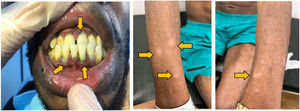 A) Gingivitis de Vincent: gingivitis ulcerativa necrotizante aguda. Encías y espacios interdentales con membranas blanco-grisáceas. B, C) Placas y nódulos hipocrómicos con superficie sutilmente descamativa.