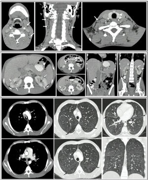 Tomografías de cuello, tórax y abdomen: A) Presencia de adenomegalias cervicales bilaterales. B) Presencia de múltiples adenopatías en el mediastino, principalmente en la región parahiliar bilateral, prevascular, pretraqueal y subcarinal. Engrosamiento de las paredes bronquiales, predominantemente en la zona central y hacia los lóbulos inferiores, además de múltiples micronódulos con densidad de tejidos blandos que formaban un patrón miliar, con diámetros menores a 3mm, presentes en ambos parénquimas pulmonares. C) Lesiones nodulares en hígado y riñón, con hepatomegalia y esplenomegalia.