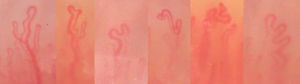 Examples of capillaries with abnormal morphologies found in several volunteers from our study. All are bifurcated and branched shape.
