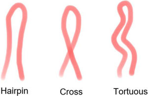Morphologies defined as normal and any different morphology presented was considered abnormal according to classification of Smith et al.3 Images of our healthy volunteers.
