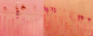 Hemosiderin microhemorrhages can be seen on the left side and non-hemosiderin microhemorrhages on the right side.