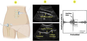 Método de escaneo multiespectrometría ecográfica por radiofrecuencia: A) Escaneo ecográfico; B) Imágenes columna lumbar y cuello femoral; C) Identificación de la región de interés (ROI) y análisis subsecuente de las señales de radiofrecuencia.
