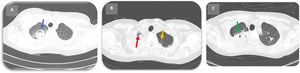 A) Lóbulo superior derecho (segmento apical y posterior): consolidación con broncograma aéreo y vidrio esmerilado periférico, necrosis o cavitaciones centrales (flecha azul) y nódulos de distribución centrolobulillar, áreas difusas de consolidación, algunas de aspecto nodular con broncograma aéreo. B) Consolidación parenquimatosa extensa apical derecha que compromete los segmentos posterior y apical del lóbulo superior, con incipiente cavitación y broncograma aéreo; aumentadas al comparar con estudio previo (flecha roja). Consolidaciones nodulares peribroncovasculares heterogéneas, con incipiente cavitación, «halo» de vidrio esmerilado predominio apical bilateral (flecha amarilla). C) Mejoría del compromiso pulmonar 10 días después de la aplicación de rituximab (flecha verde).