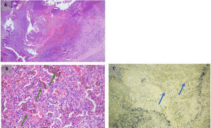A) Necrosis licuefactiva mapeada con formación de abscesos de polimorfo nucleares neutrófilos. B) Capilaritis y hemosiderófagos, un signo indirecto de hemorragia alveolar (flechas verdes). C) Coloraciones especiales de elástico con disrupción de capa túnica elástica interna de un vaso arterial por polimorfonucleares neutrófilos (flechas azules).