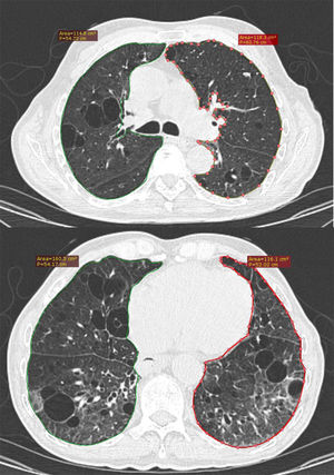 Ejemplo de medición de áreas pulmonares en cortes número 2 y 5 de escala de Goh, donde se evidencian las diferencias entre cortes apicales y basales, y derechos e izquierdos.