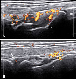 Psoriatic arthritis. Wrist. Right (A)–left (B) comparison. Ultrasound images acquired using a dorsal median longitudinal A. Evident active synovitis of the wrist. B. Subclinical mild active synovitis of the radio-carpal joint (arrow). r=radius; l=lunate bone; c=capitate bone; m=base of the third metacarpal bone.