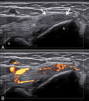 Psoriatic arthritis. Elbow. Active enthesitis of the common flexor tendon (cft) insertion into elbow medial epicondyle. A. The arrows indicate the fusiform entheseal thickening. B. Power Doppler assessment reveals intra-entheseal signal indicative of active enthesitis. u=ulna; h=humerus.