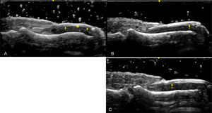 (A-C). Psoriatic Nail with Early Changes (Longitudinal View): Sonographic image obtained using Logiq e US system with an 8–18i MHz linear transducer. Observe the minimal thickening of the nail bed (*) and the slight loosening of the ventral nail plate (arrows).
