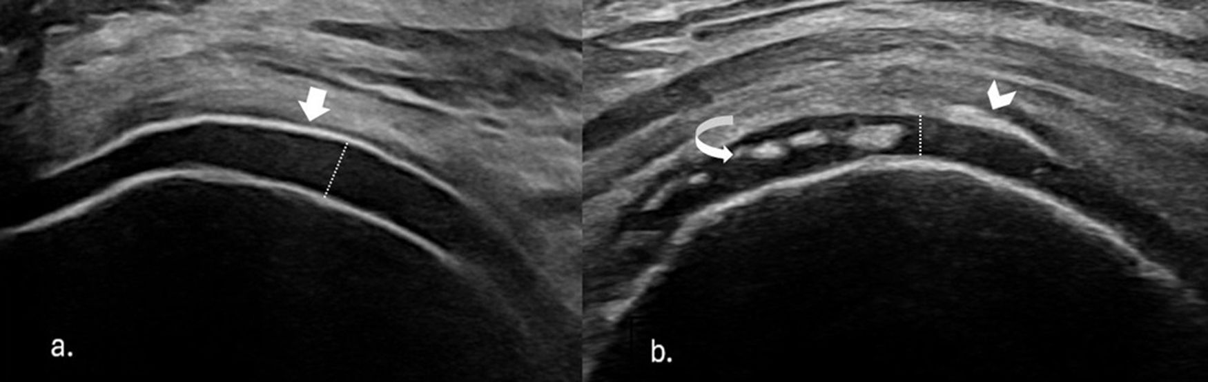 Msu Pattern Lines Update on ultrasound in crystal arthropathies | Revista Colombiana de ...