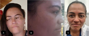 Clinical evolution. From left to right. (A) Onset of manifestations. (B) Manifestations after treatment with steroids and maximum-dose oral methotrexate. (C) Response to treatment following Rituximab administration.