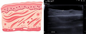 Left: visualization scheme of cutaneous structures on US in skin affected by SSc. In a transverse section with the transducer in longitudinal orientation, from superficial to deep layers, the stratum corneum, the epidermis, and the basal cell layer are observed. Deeper, the dermis is visible, showing an absence of vascular structures and a marked thickening compared to normal skin. This dermal thickening, as illustrated in the diagram, is caused by prominent collagen fiber deposition. Note the scarce inflammatory infiltrate and the predominance of collagen fibers and extracellular matrix. Right: clinical skin US image showing changes due to SSc, with skin thickening primarily dependent on increased dermal thickness. The US image on the right, labeled D1, shows the measured epidermal thickness in a patient with the disease, which is 0.56mm. The cutaneous thickening in the pathophysiological process of the disease is primarily due to increased dermal thickness.