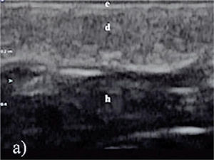 Normal ultrasound appearance of the skin with its differentiated layers: e: epidermis; d: dermis; h: hypodermis. (Image taken from Ref. [30]).