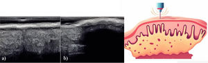 Left: (a) epidermal thickening in a psoriatic plaque; (b) posterior acoustic shadowing in a case of severe psoriatic plaque (images taken from Ref. [30]). Right: diagram of the skin in long-axis view with an HFUS transducer. From superficial to deep layers, the following are observed: thickened stratum corneum (parakeratosis), an enlarged epidermis with proliferative activity, and dermal infiltration with inflammatory cells without fibrosis or increased collagen fibers. Unlike SSc, there is no associated dermal fibrosis, and the inflammatory infiltrate is usually prominent.