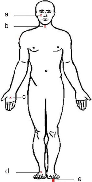 The five body sites for ultrasonographic skin measurement: (a) cheeks: at the zygomatic arch below the orbits; (b) neck: anterior neck over the cricoid arch; (c) palms: center of the right palm, 5cm proximal to the metacarpophalangeal joints; (d) dorsum of the foot: dorsum of the right foot, 5cm proximal to the metatarsophalangeal joints; (e) soles: center of the right sole, 10cm proximal to the metatarsophalangeal joints.