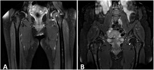 Caso clínico 1. A) RMN corte coronal en STIR donde se observa edema de médula ósea (estrella) que afecta a cabeza femoral izquierda. B) RMN corte coronal en T1.