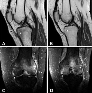 Caso clínico 2. A y B) RMN corte sagital en T1 donde se observa edema óseo en epífisis tibial proximal derecha hipointenso. C y D) RMN corte coronal de la misma articulación en T2, en el que se observa el edema óseo hiperintenso.