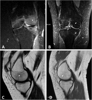 Caso clínico 3. Edema óseo bilateral de cóndilos femorales, predominantemente en compartimento externo (A y B corte coronal; C y D corte sagital).