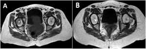 Caso clínico 4. RMN corte axial. Edema óseo hipointenso en T1 (A) e hiperintenso en T2 (B) en cabeza femoral derecha (estrella) y de forma muy discreta en la izquierda.