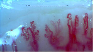 Non-specific pattern. Patient with LES, ANAS 1:320 homogeneous pattern, without ENAS data, with Raynaud phenomenon, without cutaneous injuries. Videocapillaroscopy 200×, with non-specific pattern, given by capillaries greater than 20μm and multiple hemorrhages.