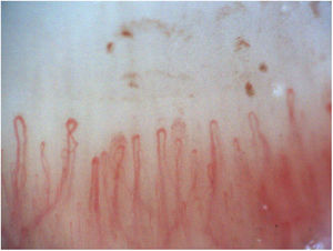 Sclerosis systemic like pattern. Patient with LES, ANAS 1:160 speckled pattern, RNP >200, Sm 109, Raynaud phenomenon. No digital ulcer. Videocapillaroscopy 200×, with sclerosis systemic like pattern, given by decrease in the number of capillaries, capillaries greater than 20μm and presence of arborescent capillaries.