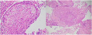 Histología de ganglio cervical y pulmón donde se observan granulomas desnudos o reacción granulomatosa de tipo sarcoidal.
