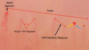Image showing the measurements considered in 1 linear millimeter: apical diameter (in a dilated capillary), intercapillary distance, arterial loop (yellow arrow), venous loop (blue arrow), internal diameter (between the venous and arterial loop).
