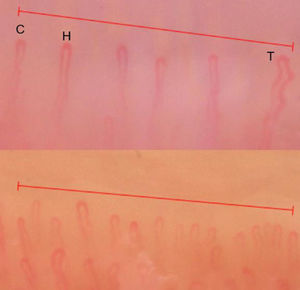 Image showing in the upper part, a density of 6capillaries/mm. Normal capillaries of several morphologies: hairpin (H), crossed (C), and tortuous (T). In the lower part, a density of 12capillaries/mm is observed.
