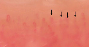 Capillaries with a morphology that cannot be classified due to focus limitations in part of the visualized field (arrows).