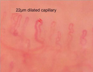 Dilated capillary of 22.8μm, accompanied by non-dilated capillaries.