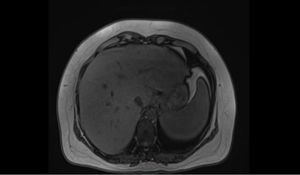 Resonancia magnética de abdomen con contraste, evidencia de múltiples lesiones redondeadas confluentes que comprometen en forma difusa todos los segmentos hepáticos, sin realce significativo posteriormente a la administración de contraste IV, compatibles con granulomas hepáticos. IV: intravenoso.