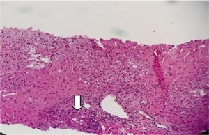 Biopsia de hígado con tinción de hematoxilina y eosina con aumento ×10 en donde se evidencia la presencia de un granuloma no necrotizante (flecha blanca).